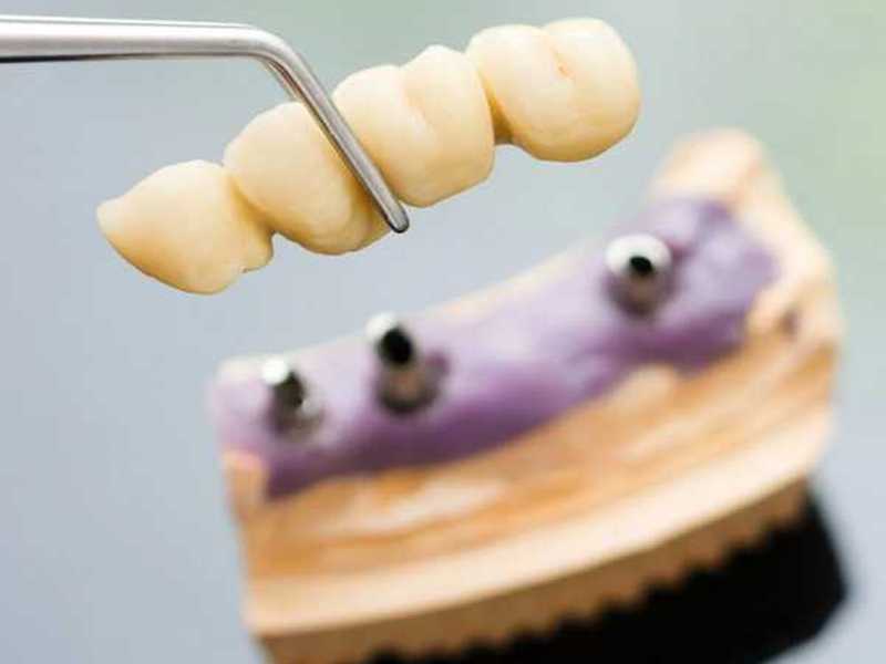 zobni mostiček za zapolnitev vrzeli manjkajočih zob